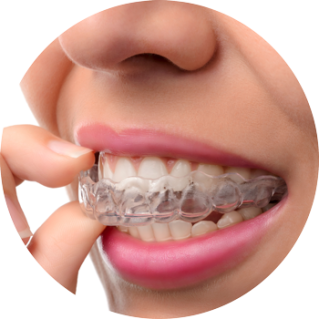 Aligner - Durchsichtige Zahnspangen von Invisalign